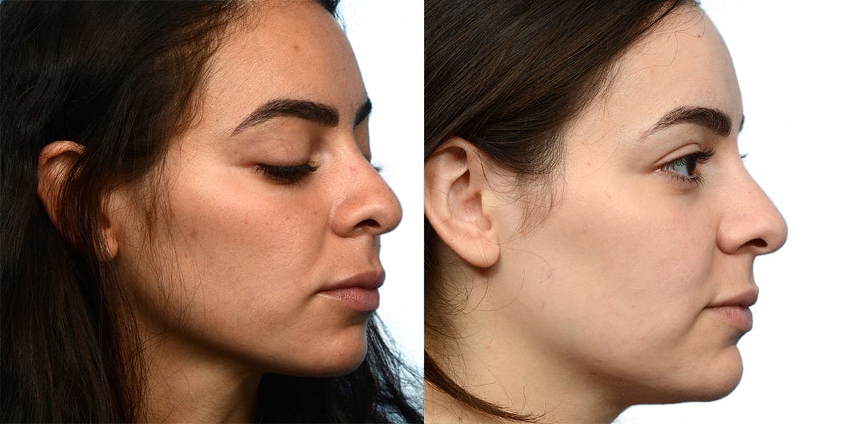 VBeam® Before & After Gallery - Patient 104547 - Image 3