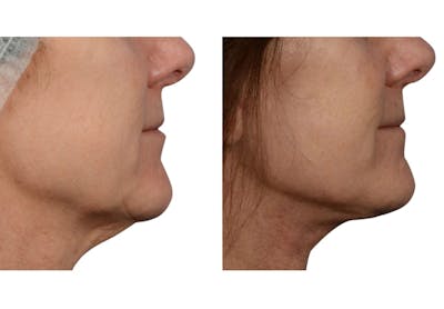 Ultherapy® Before & After Gallery - Patient 332489 - Image 1