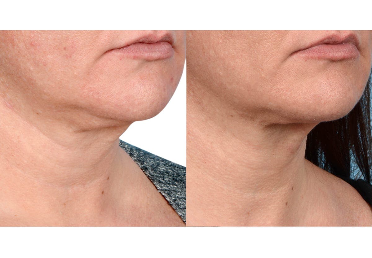 Ultherapy® Before & After Gallery - Patient 286646 - Image 1