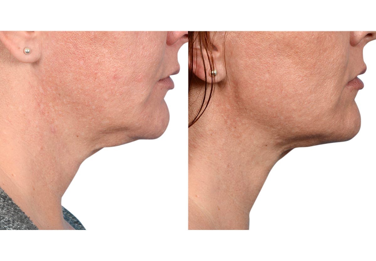Ultherapy® Before & After Gallery - Patient 286646 - Image 2