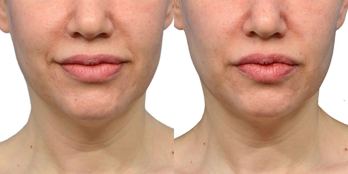 Ultherapy® Before & After Gallery - Patient 312573 - Image 1