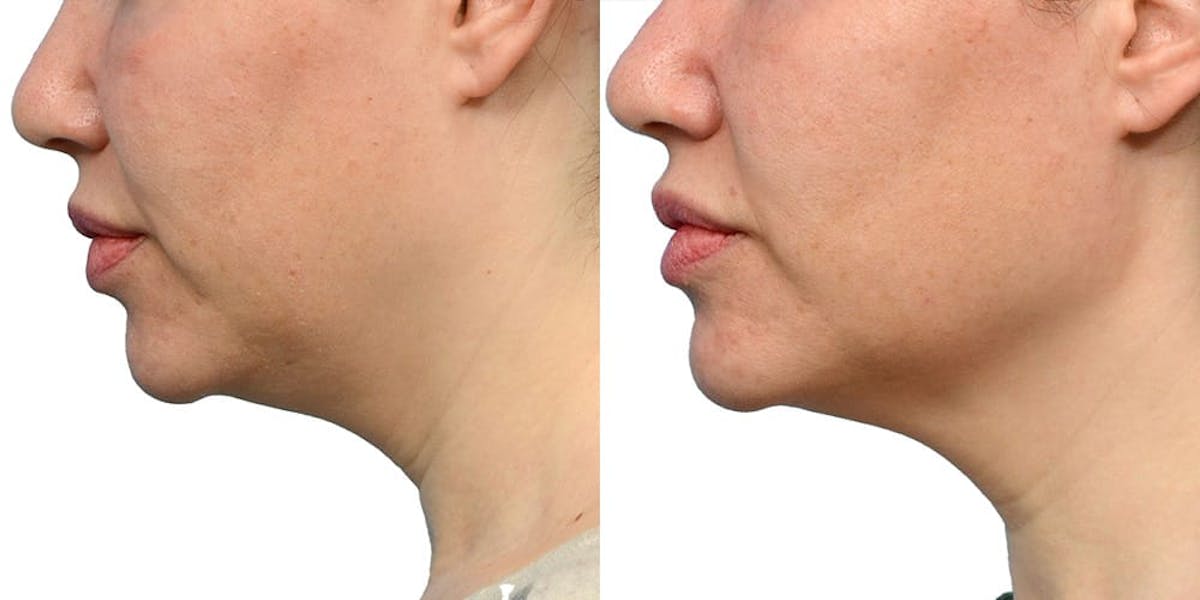Ultherapy® Before & After Gallery - Patient 312573 - Image 3