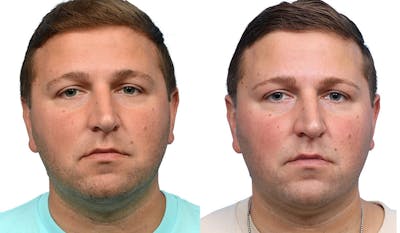 Ultherapy® Before & After Gallery - Patient 405374 - Image 1
