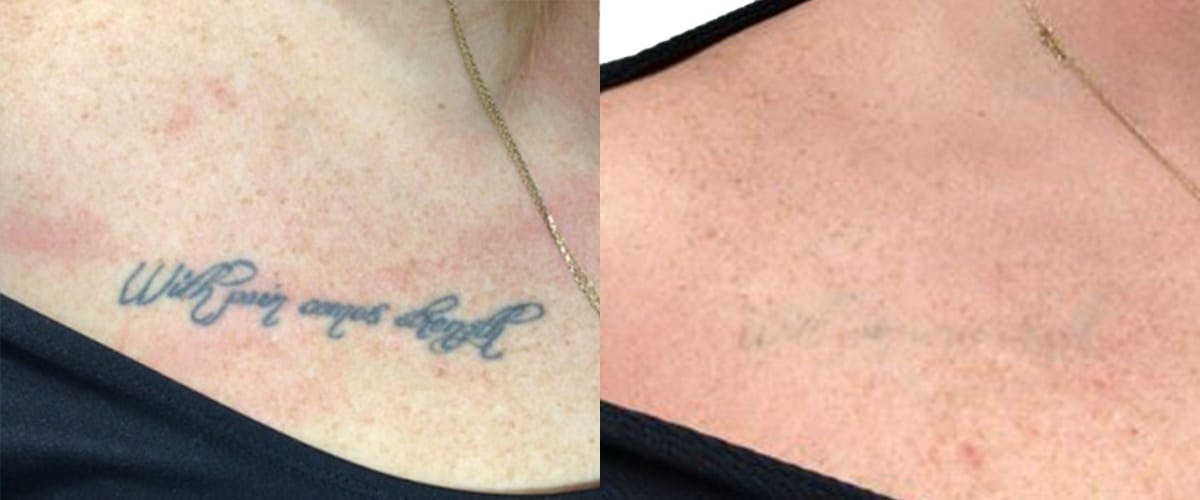 Tattoo Removal Before & After Gallery - Patient 219532 - Image 1