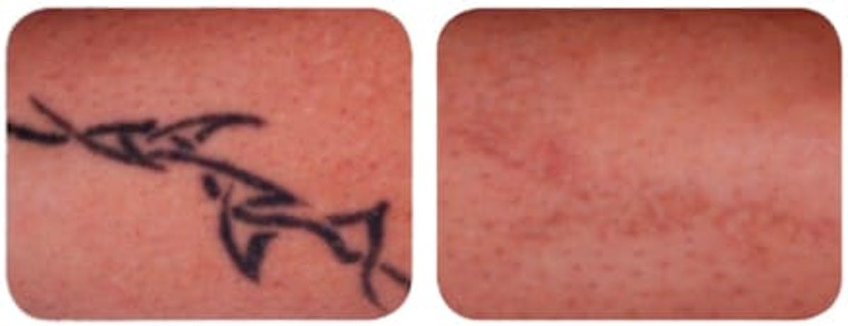 Tattoo Removal Before & After Gallery - Patient 149911 - Image 1