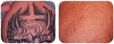 Tattoo Removal Before & After Gallery - Patient 349264 - Image 1