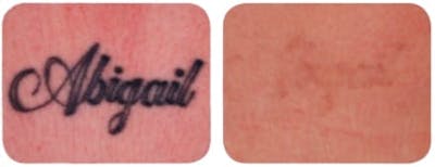 Tattoo Removal Before & After Gallery - Patient 501654 - Image 1