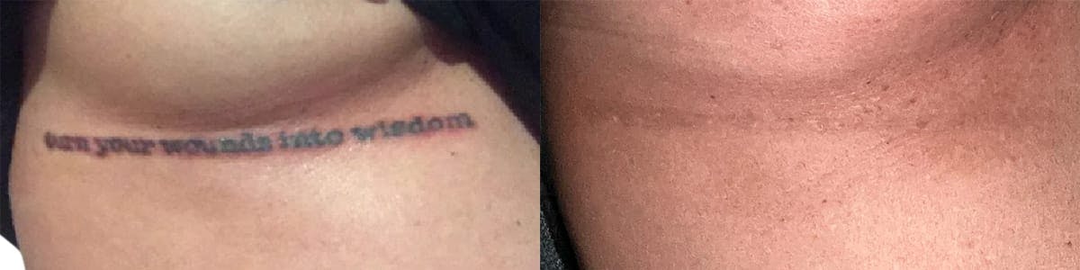Tattoo Removal Before & After Gallery - Patient 418956 - Image 1