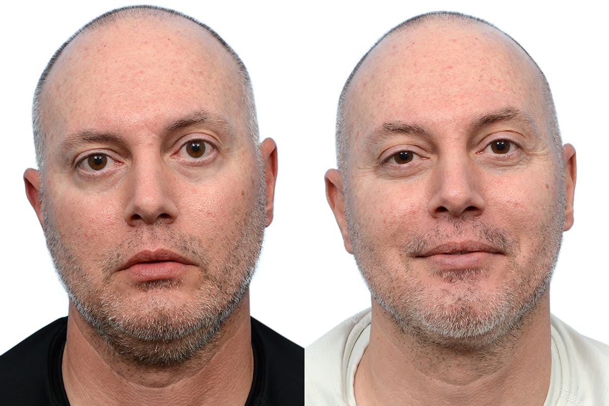 Submentoplasty Before & After Gallery - Patient 190021 - Image 1