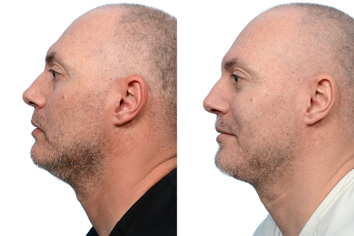Submentoplasty Before & After Gallery - Patient 190021 - Image 2