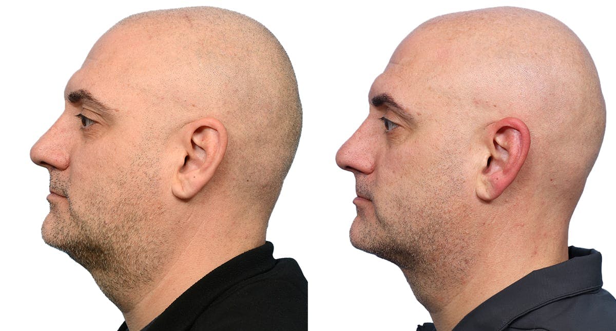 Submentoplasty Before & After Gallery - Patient 163166 - Image 2