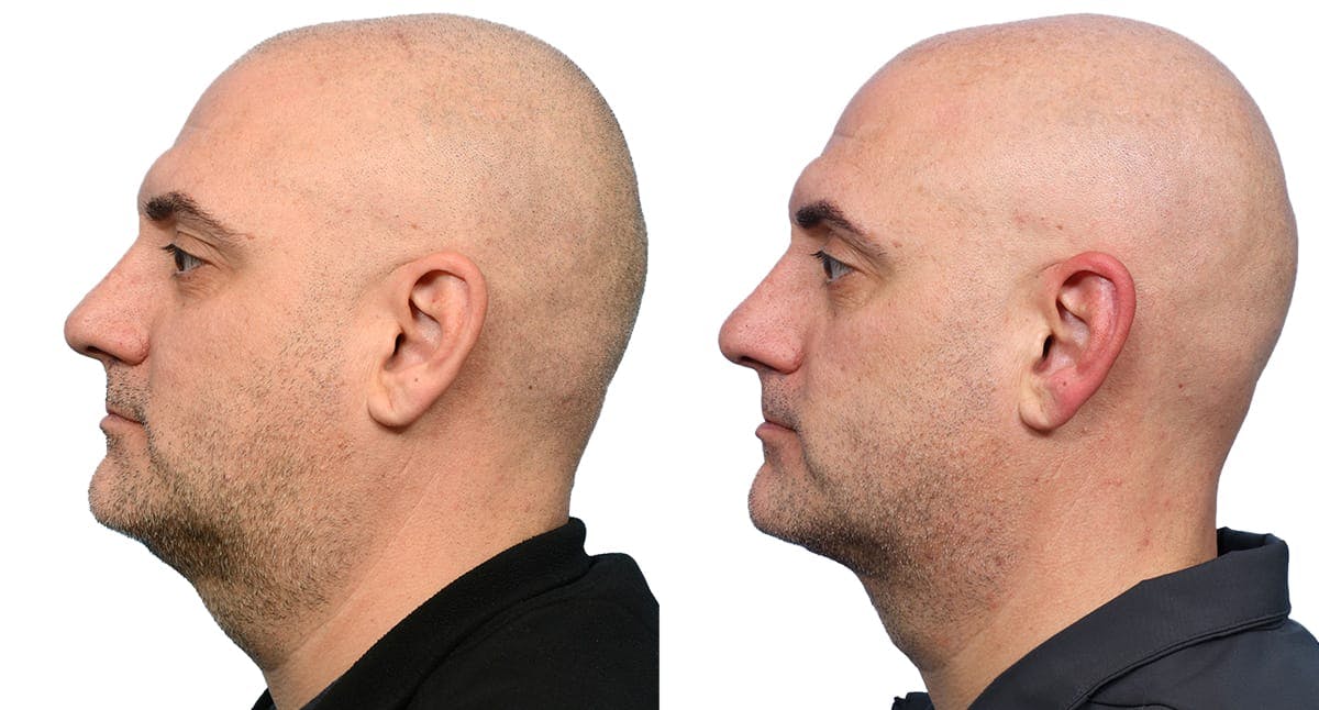 Submentoplasty Before & After Gallery - Patient 163166 - Image 2