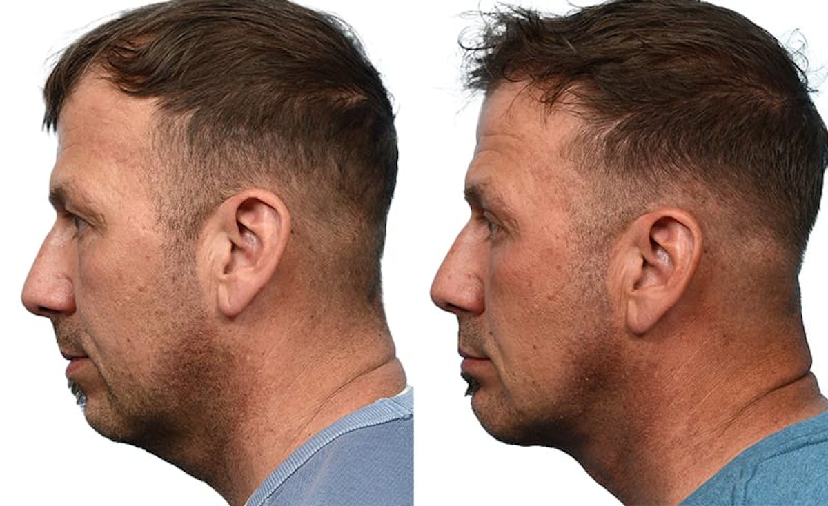 Submentoplasty Before & After Gallery - Patient 192180 - Image 3