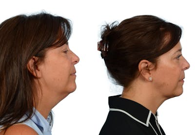 Submental Liposuction Before & After Gallery - Patient 268879 - Image 1