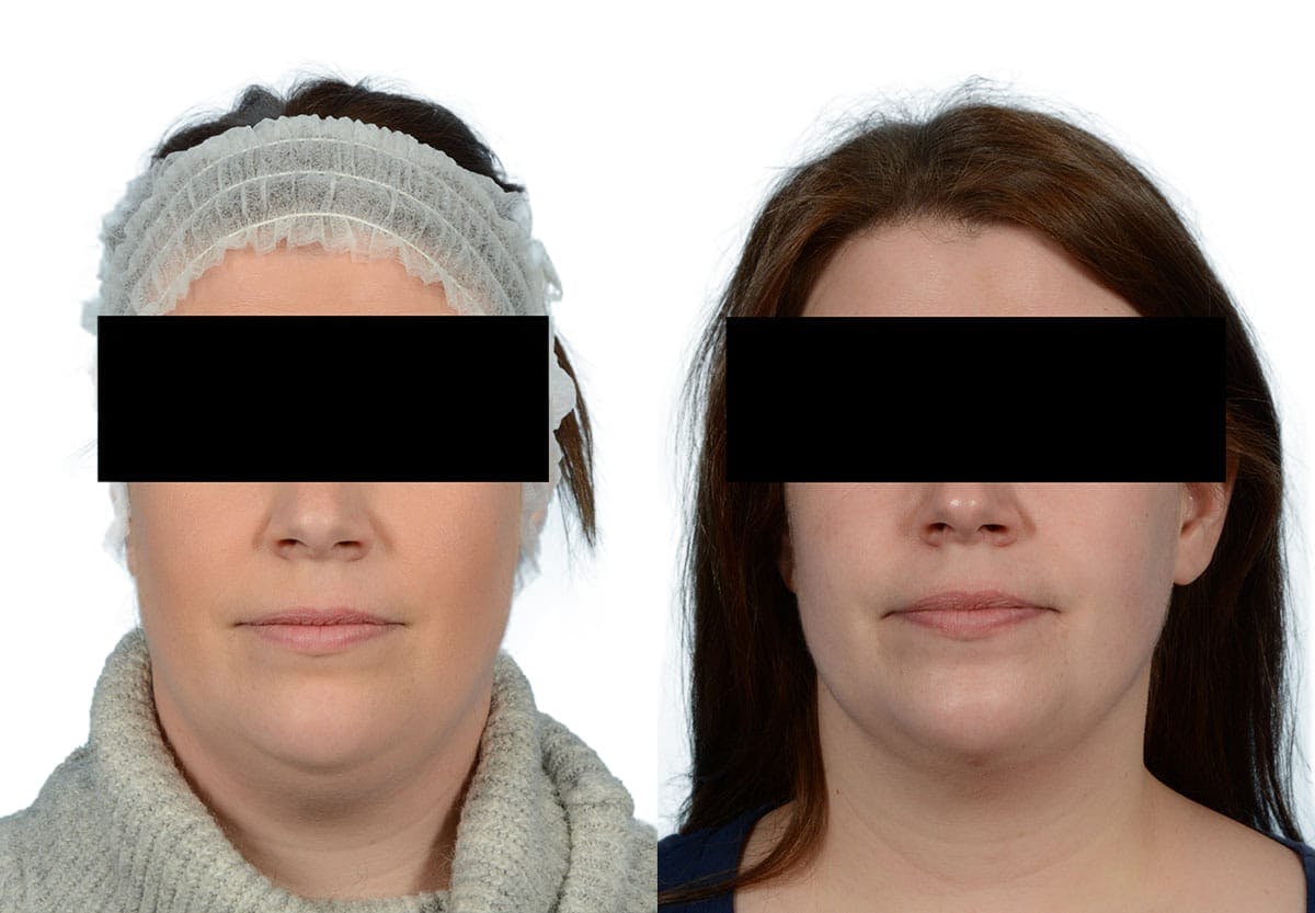 Submental Liposuction Before & After Gallery - Patient 329835 - Image 2