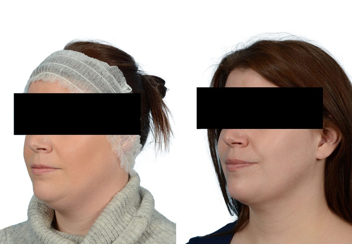 Submental Liposuction Before & After Gallery - Patient 329835 - Image 3