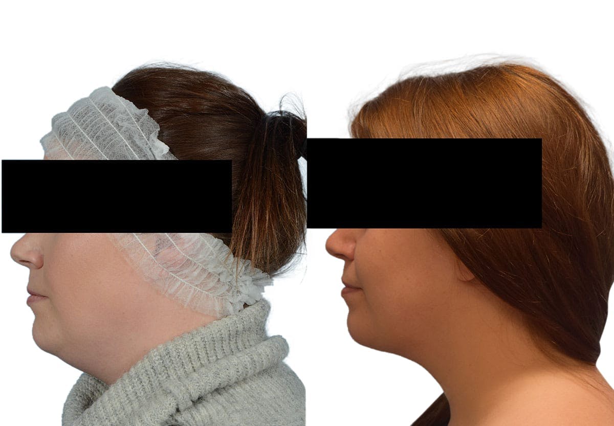 Submental Liposuction Before & After Gallery - Patient 329835 - Image 1