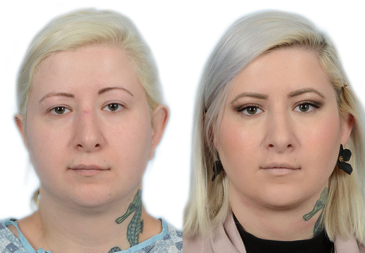 Submental Liposuction Before & After Gallery - Patient 203804 - Image 2