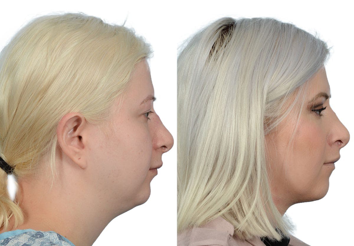 Submental Liposuction Before & After Gallery - Patient 203804 - Image 3