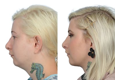 Submental Liposuction Before & After Gallery - Patient 203804 - Image 1