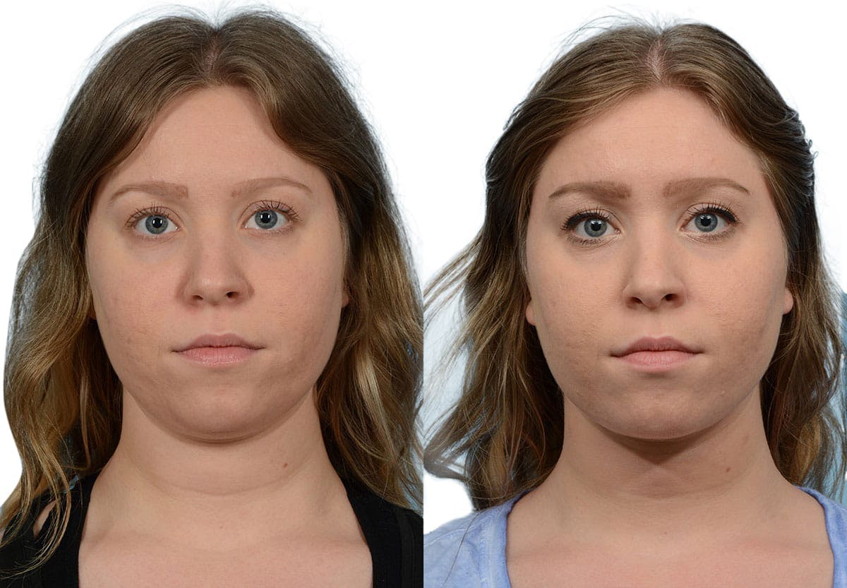 Submental Liposuction Before & After Gallery - Patient 328904 - Image 2