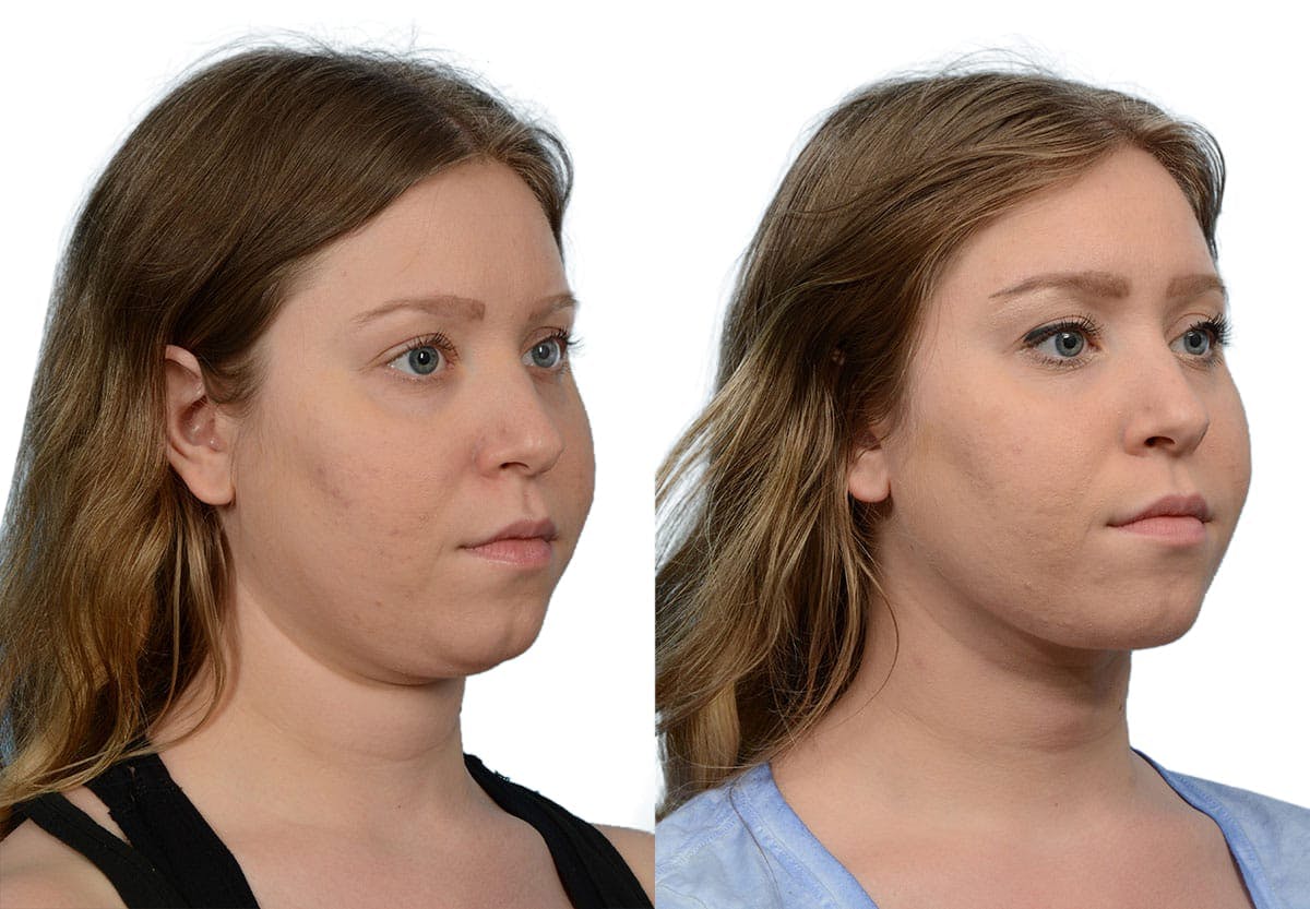 Submental Liposuction Before & After Gallery - Patient 328904 - Image 3