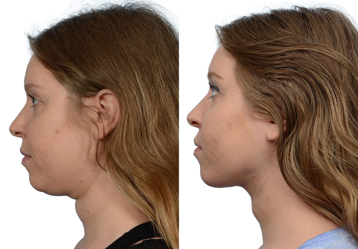 Submental Liposuction Before & After Gallery - Patient 328904 - Image 1