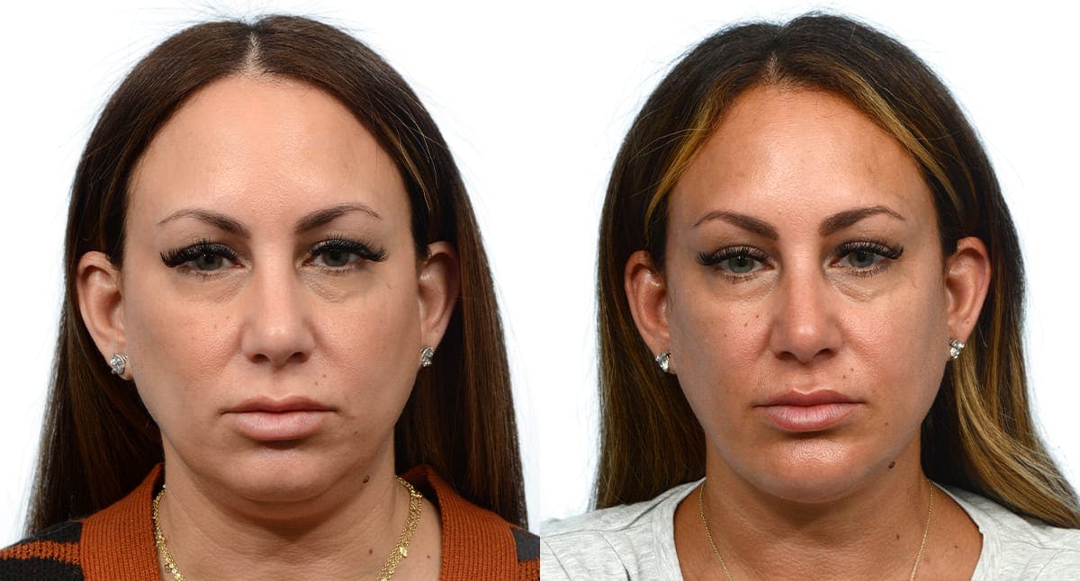 Submental Liposuction Before & After Gallery - Patient 247330 - Image 2