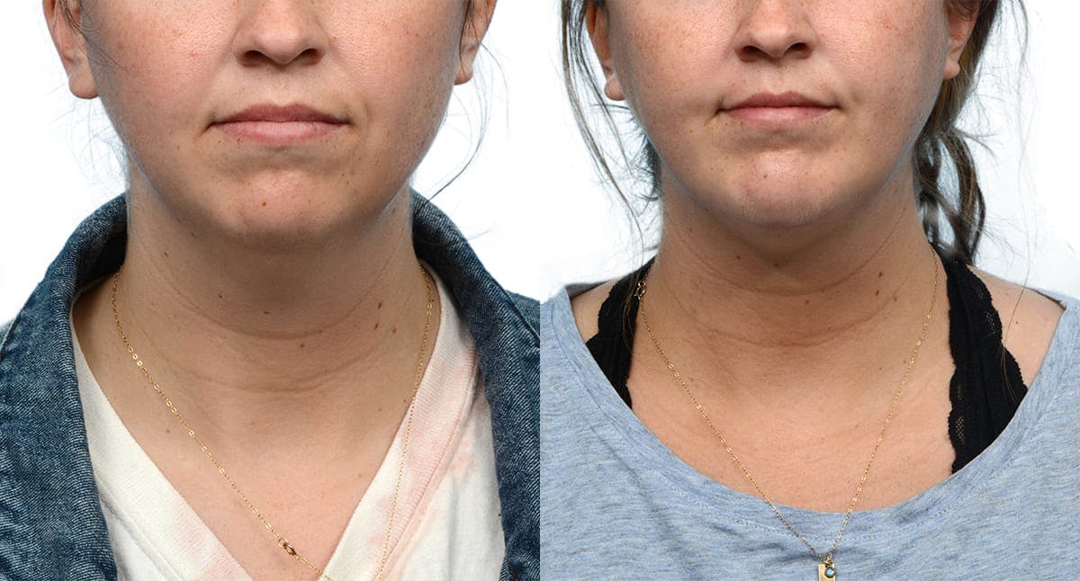 Submental Liposuction Before & After Gallery - Patient 178416 - Image 2