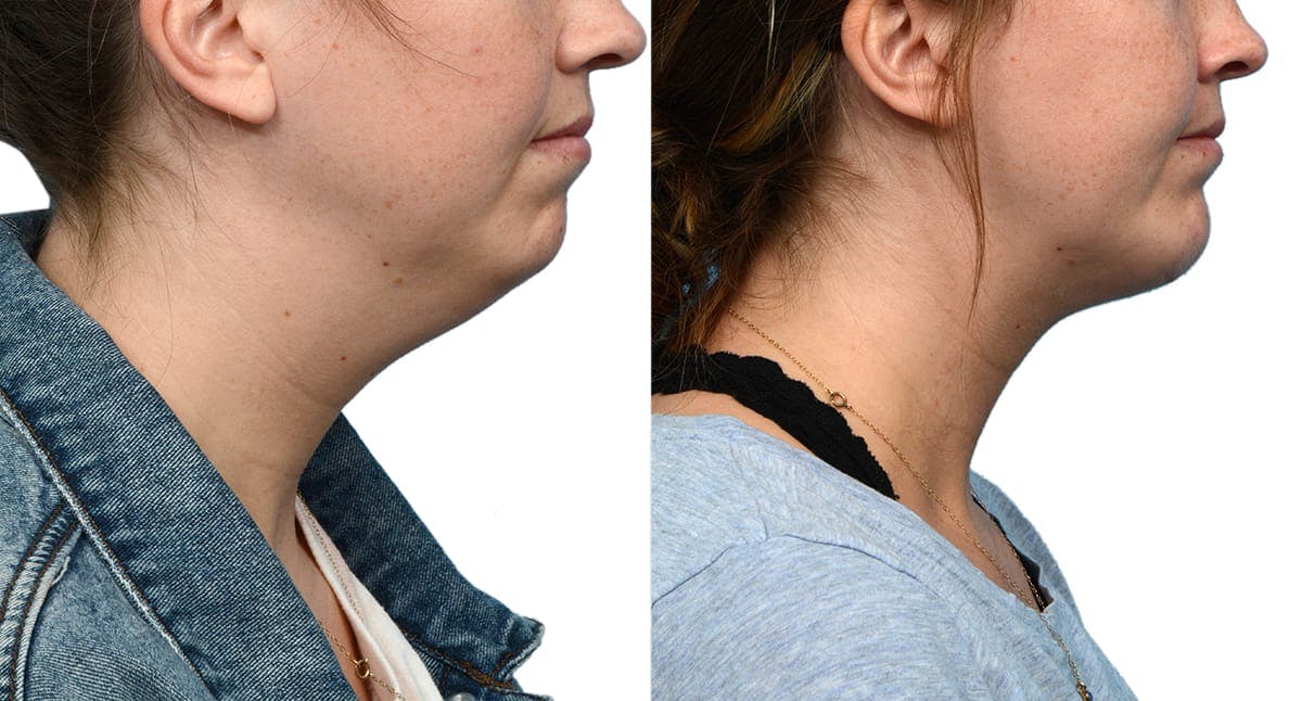 Submental Liposuction Before & After Gallery - Patient 178416 - Image 3