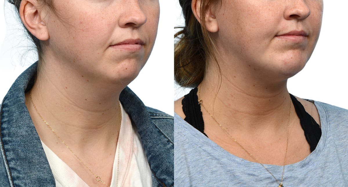 Submental Liposuction Before & After Gallery - Patient 178416 - Image 4