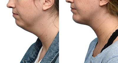 Submental Liposuction Before & After Gallery - Patient 178416 - Image 1