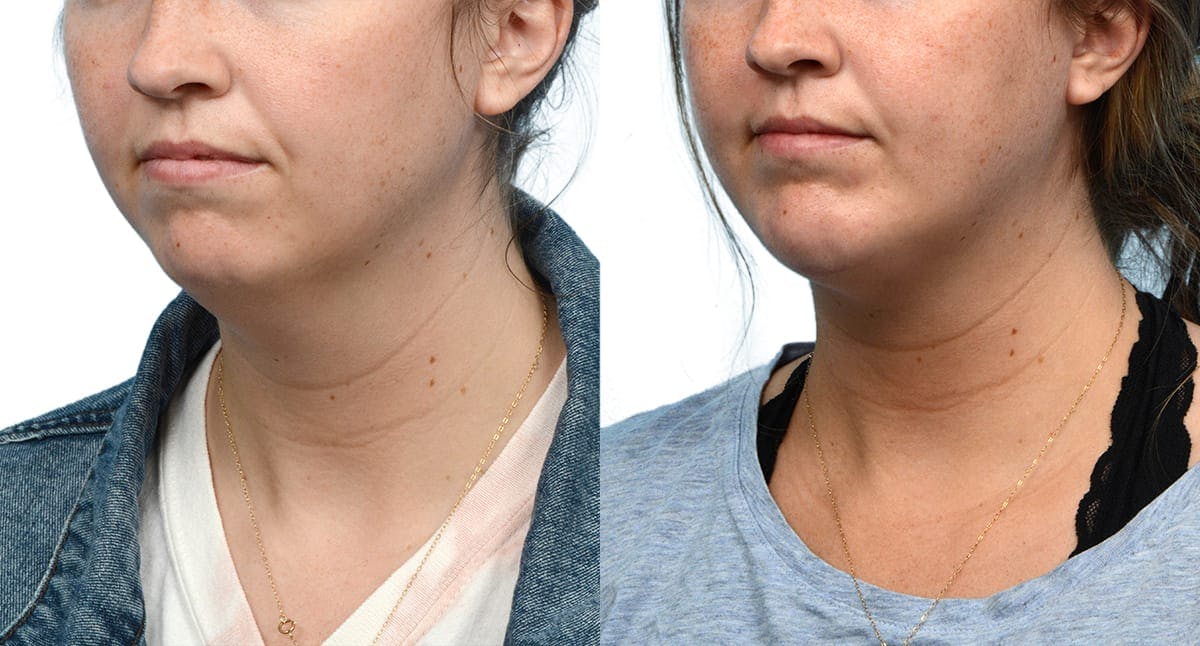 Submental Liposuction Before & After Gallery - Patient 178416 - Image 5