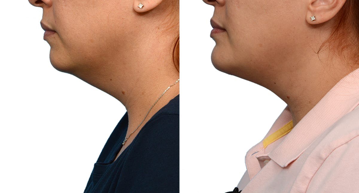 Submental Liposuction Before & After Gallery - Patient 370975 - Image 1