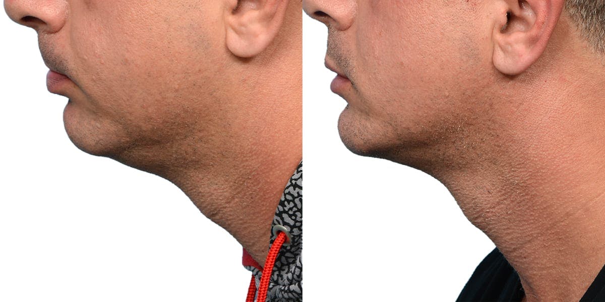 Submental Liposuction Before & After Gallery - Patient 129285 - Image 1