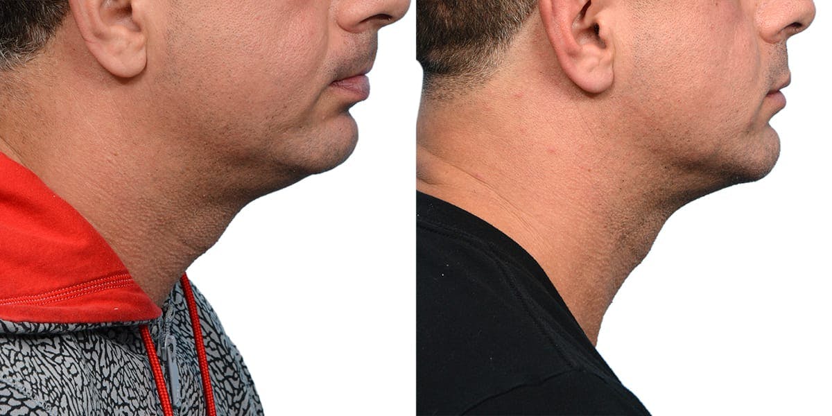 Submental Liposuction Before & After Gallery - Patient 129285 - Image 4