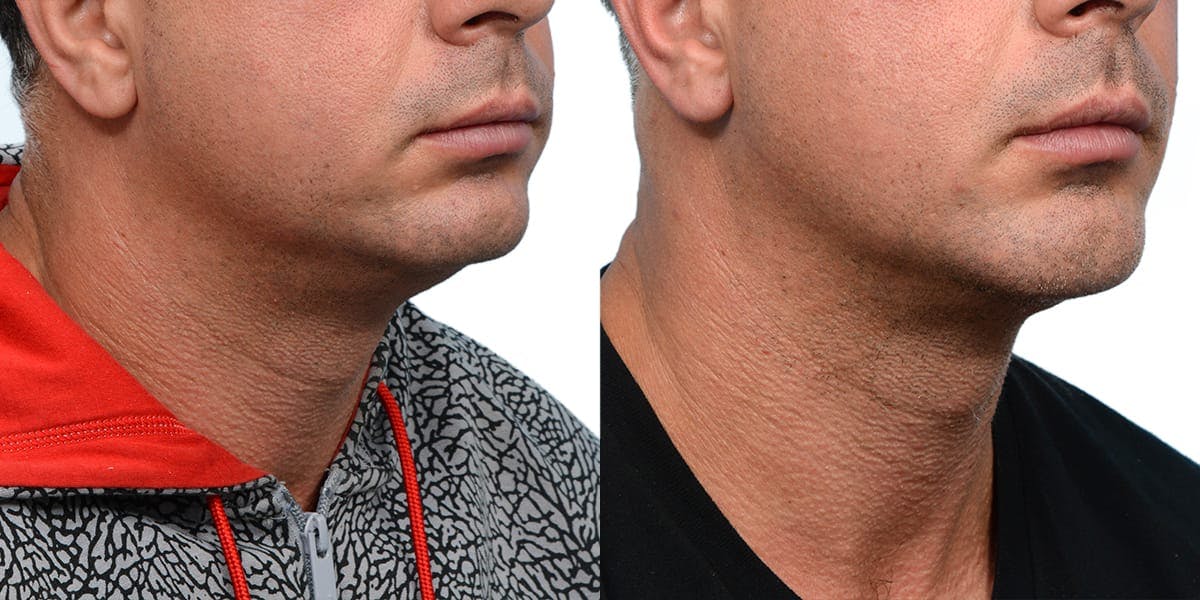 Submental Liposuction Before & After Gallery - Patient 129285 - Image 5