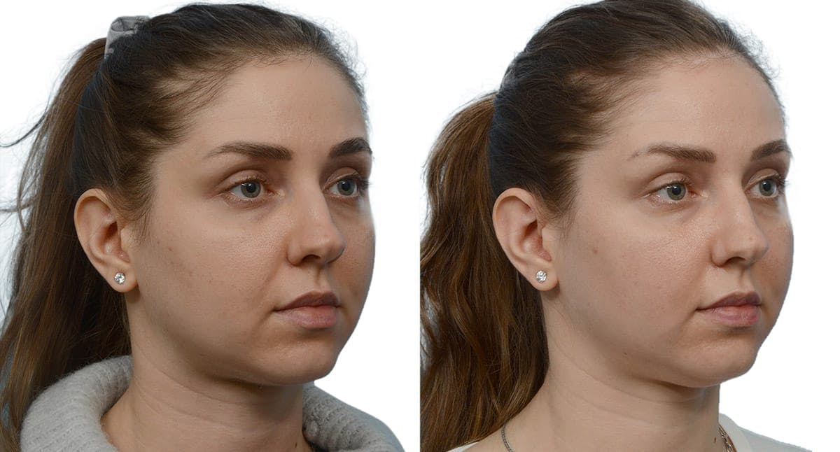 Submental Liposuction Before & After Gallery - Patient 217808 - Image 2