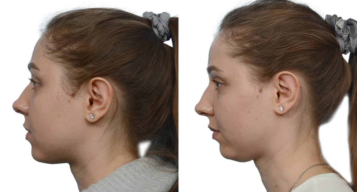 Submental Liposuction Before & After Gallery - Patient 217808 - Image 1