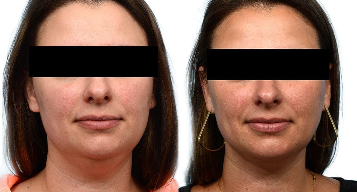 Submental Liposuction Before & After Gallery - Patient 903180 - Image 2