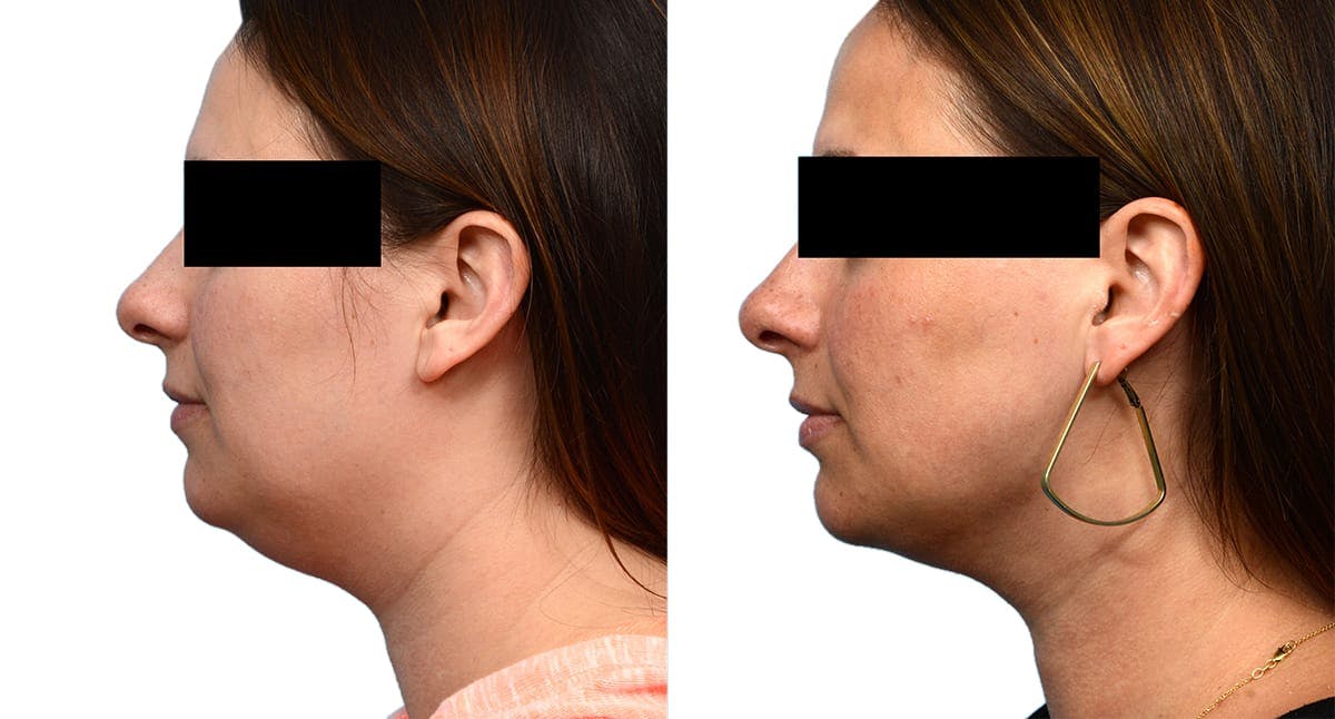 Submental Liposuction Before & After Gallery - Patient 903180 - Image 1