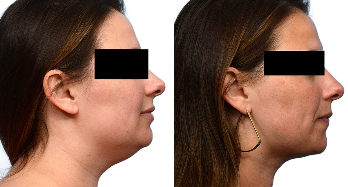 Submental Liposuction Before & After Gallery - Patient 903180 - Image 3