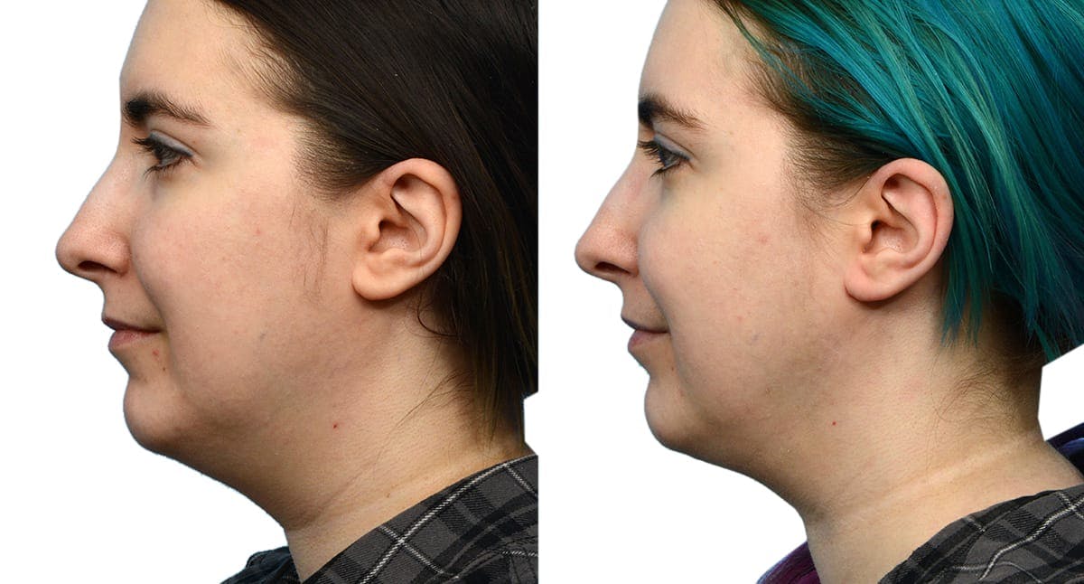 Submental Liposuction Before & After Gallery - Patient 349076 - Image 1