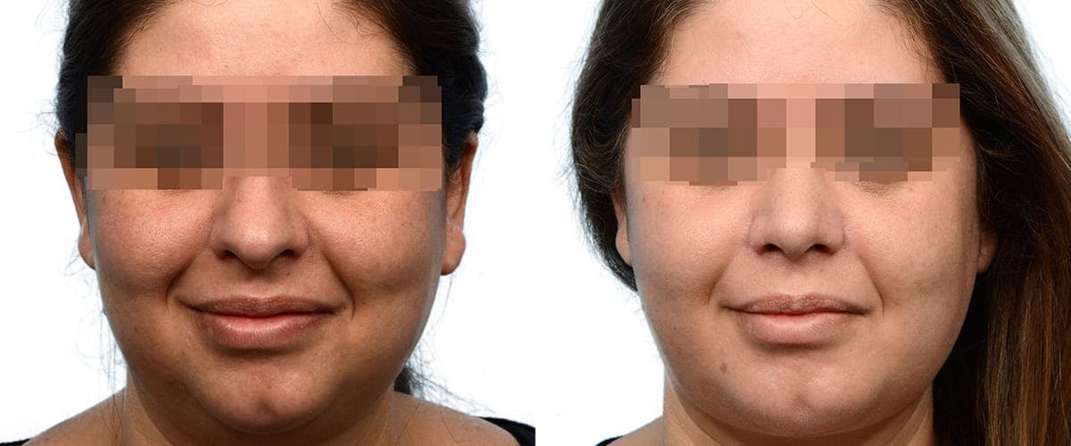 Submental Liposuction Before & After Gallery - Patient 834179 - Image 2