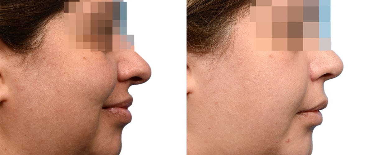 Submental Liposuction Before & After Gallery - Patient 834179 - Image 1