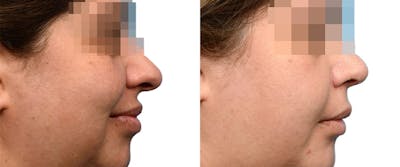 Submental Liposuction Before & After Gallery - Patient 834179 - Image 1