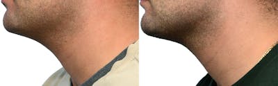 Submental Liposuction Before & After Gallery - Patient 321296 - Image 1