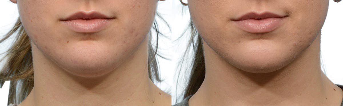 Submental Liposuction Before & After Gallery - Patient 213660 - Image 2