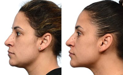 Submental Liposuction Before & After Gallery - Patient 289412 - Image 1