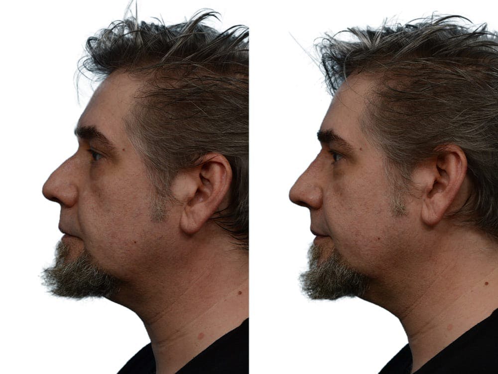 Non-Surgical Rhinoplasty Before & After Gallery - Patient 386470 - Image 1